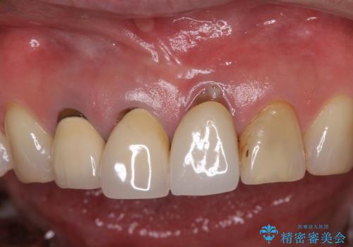 抜かなければいけない前歯 歯肉移植を用いたオールセラミックブリッジの治療前