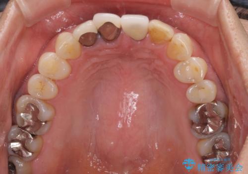 抜かなければいけない前歯 歯肉移植を用いたオールセラミックブリッジの治療前