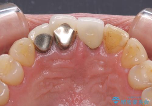 抜かなければいけない前歯 歯肉移植を用いたオールセラミックブリッジの治療前