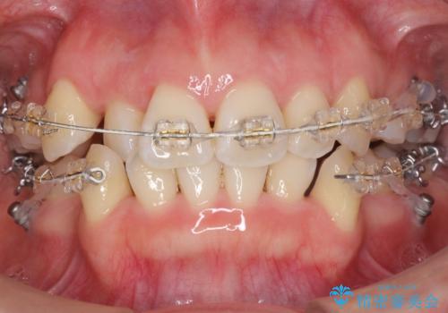 美容整形よりも、自然な美しさを。口元は大事です。の治療中