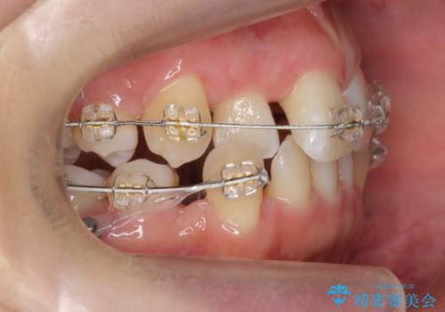 美容整形よりも、自然な美しさを。口元は大事です。の治療中