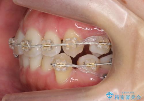 美容整形よりも、自然な美しさを。口元は大事です。の治療中