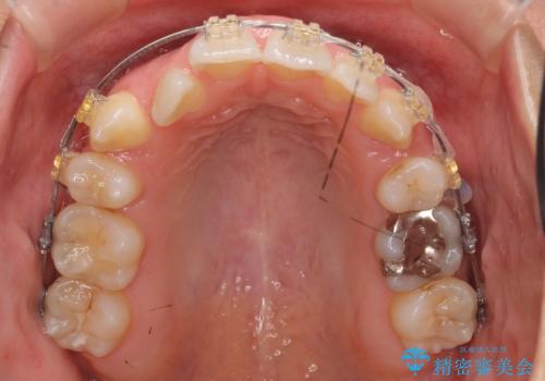 美容整形よりも、自然な美しさを。口元は大事です。の治療中