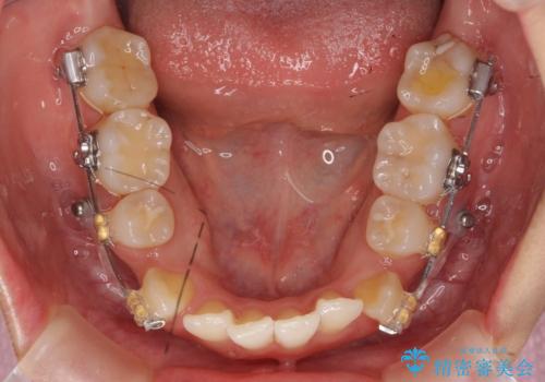 美容整形よりも、自然な美しさを。口元は大事です。の治療中