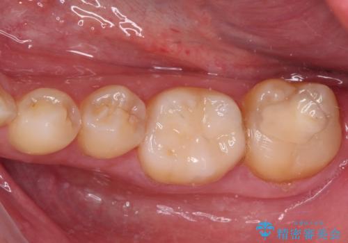 海外赴任前に気になる虫歯を治療したいの症例 治療後