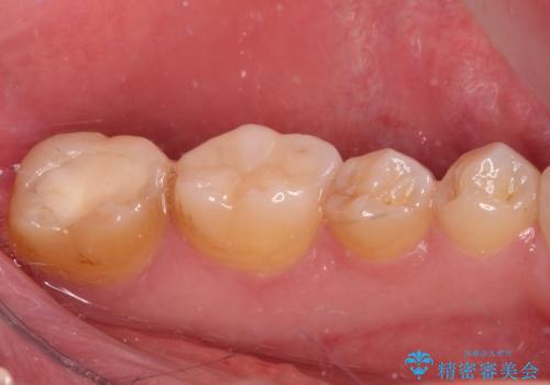 海外赴任前に気になる虫歯を治療したいの治療後