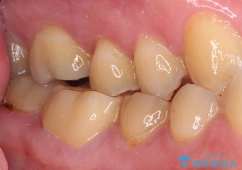 海外赴任前に気になる虫歯を治療したいの治療後