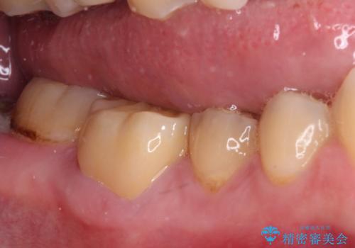 海外赴任前に気になる虫歯を治療したいの治療後