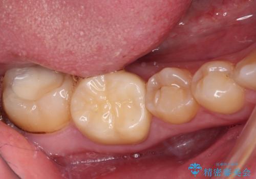 海外赴任前に気になる虫歯を治療したいの治療後