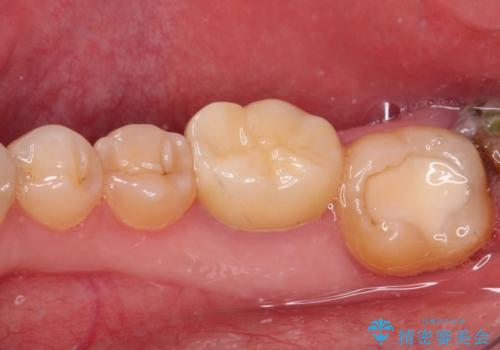 海外赴任前に気になる虫歯を治療したいの治療後