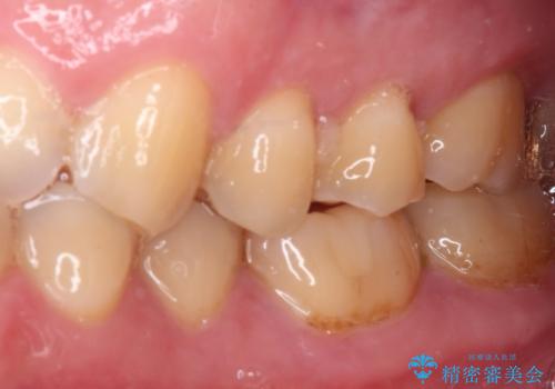 海外赴任前に気になる虫歯を治療したいの治療後