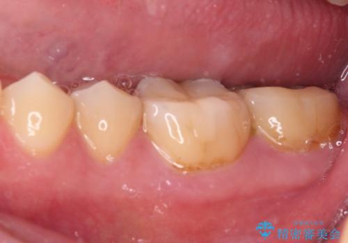 海外赴任前に気になる虫歯を治療したいの治療後