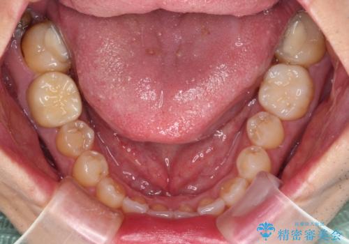 海外赴任前に気になる虫歯を治療したいの治療後