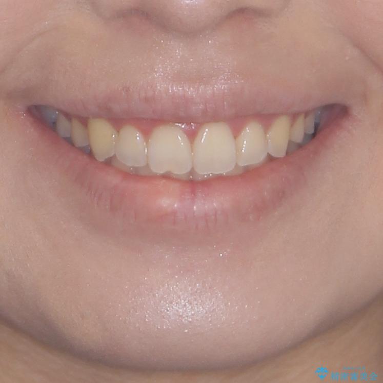 前歯のデコボコをインビザラインでスッキリとの治療後(顔貌)