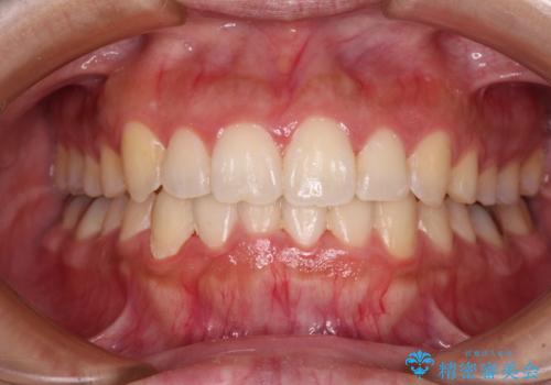 前歯のデコボコをインビザラインでスッキリとの症例 治療後