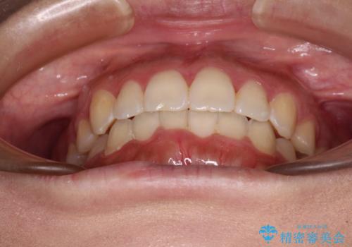 前歯のデコボコをインビザラインでスッキリとの治療後