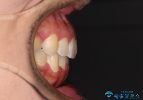 前歯のデコボコをインビザラインでスッキリとの治療後