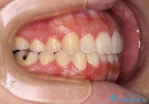 前歯のデコボコをインビザラインでスッキリとの治療後