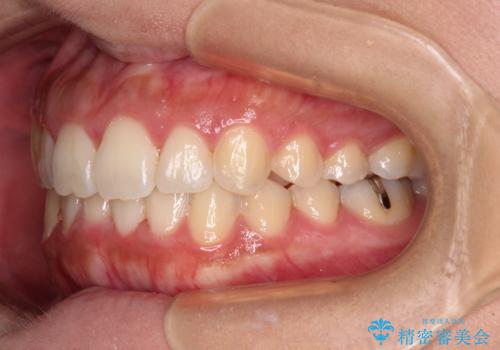 前歯のデコボコをインビザラインでスッキリとの治療後