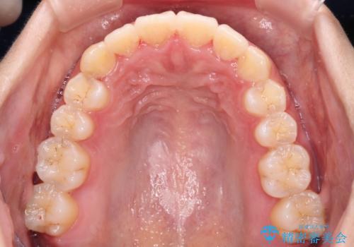 前歯のデコボコをインビザラインでスッキリとの治療後