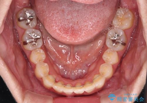 前歯のデコボコをインビザラインでスッキリとの治療後