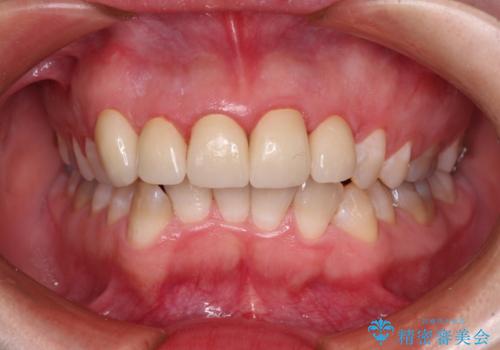 不揃いな前歯のセラミックが気になる オールセラミッククラウンによる補綴治療の治療後