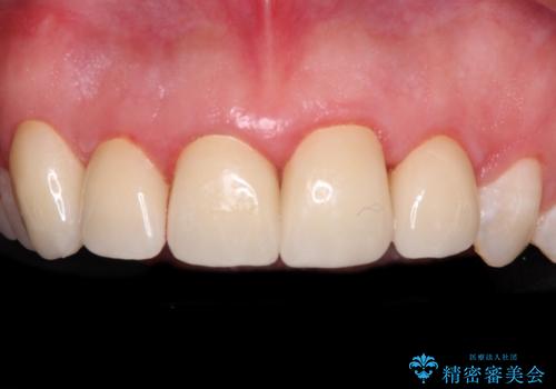 不揃いな前歯のセラミックが気になる オールセラミッククラウンによる補綴治療の治療後
