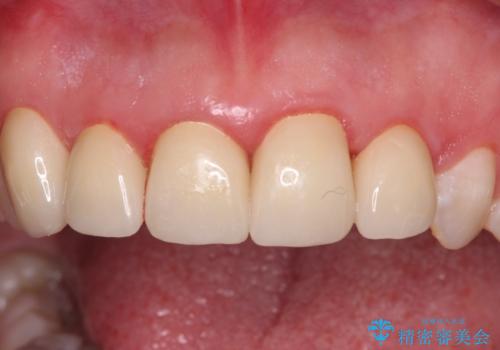 不揃いな前歯のセラミックが気になる オールセラミッククラウンによる補綴治療の治療後