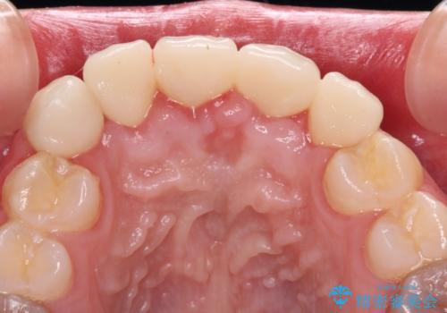 不揃いな前歯のセラミックが気になる オールセラミッククラウンによる補綴治療の治療後