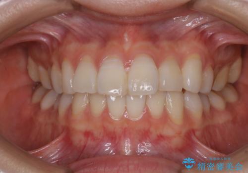 矯正治療が終わったタイミングでPMTCの治療前