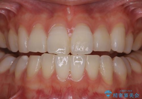 矯正治療が終わったタイミングでPMTCの治療前