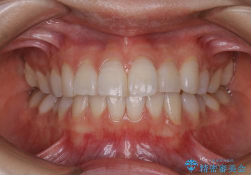 矯正治療が終わったタイミングでPMTCの治療後