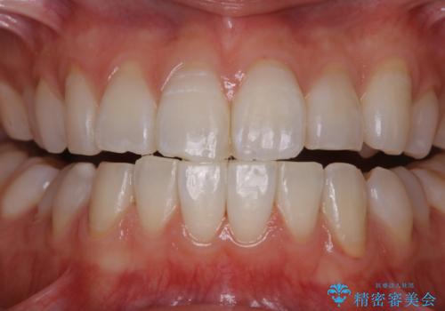 矯正治療が終わったタイミングでPMTCの治療後