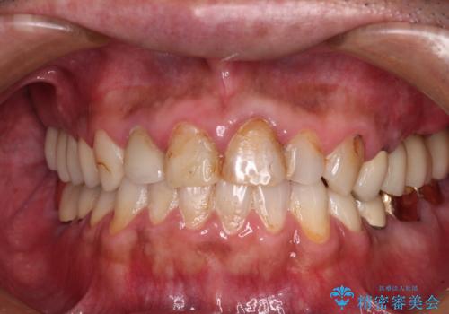 抜歯が必要な左右の奥歯　ブリッジとインプラントによる奥歯の補綴治療の症例 治療後