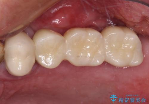 抜歯が必要な左右の奥歯　ブリッジとインプラントによる奥歯の補綴治療