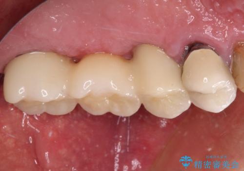 抜歯が必要な左右の奥歯 ブリッジとインプラントによる奥歯の補綴治療の治療後