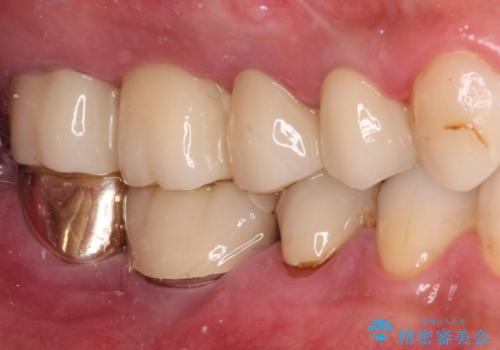 抜歯が必要な左右の奥歯 ブリッジとインプラントによる奥歯の補綴治療の治療後