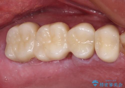 抜歯が必要な左右の奥歯 ブリッジとインプラントによる奥歯の補綴治療の治療後
