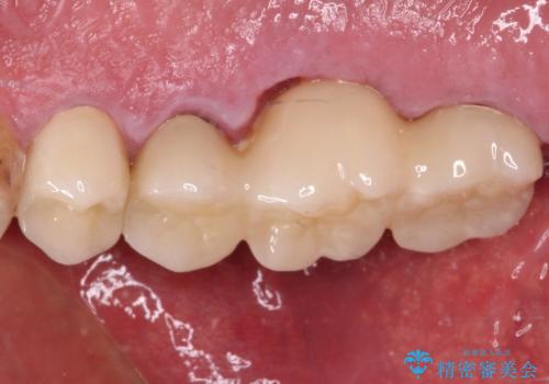 抜歯が必要な左右の奥歯　ブリッジとインプラントによる奥歯の補綴治療の治療後