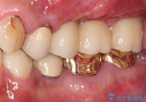 抜歯が必要な左右の奥歯 ブリッジとインプラントによる奥歯の補綴治療の治療後