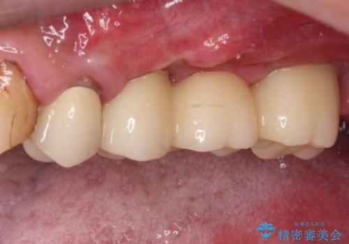 抜歯が必要な左右の奥歯 ブリッジとインプラントによる奥歯の補綴治療の治療後