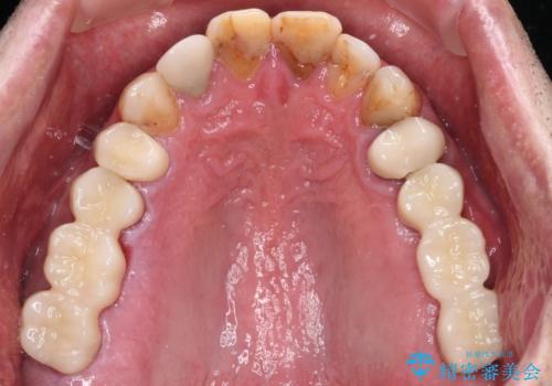 抜歯が必要な左右の奥歯 ブリッジとインプラントによる奥歯の補綴治療の治療後