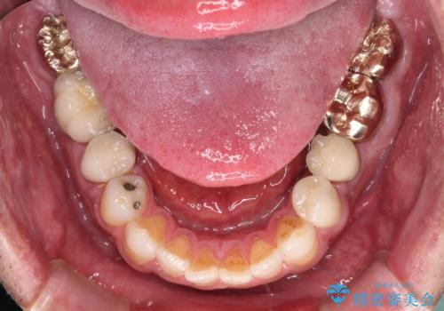 抜歯が必要な左右の奥歯 ブリッジとインプラントによる奥歯の補綴治療の治療後