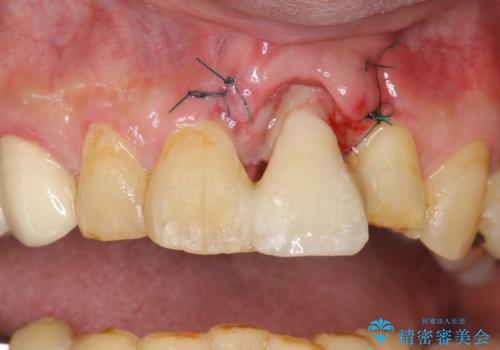 折れた前歯を使えるように、抜かないで残す方法の治療後