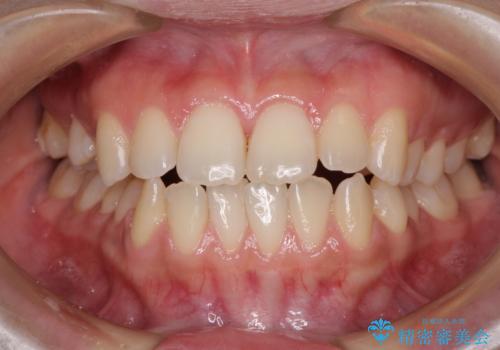 上顎骨拡大を用いたインビザラインによる非抜歯矯正の治療中