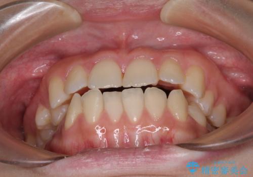 上顎骨拡大を用いたインビザラインによる非抜歯矯正の治療中