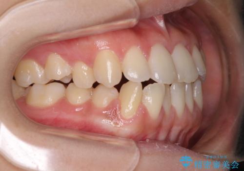 上顎骨拡大を用いたインビザラインによる非抜歯矯正の治療中