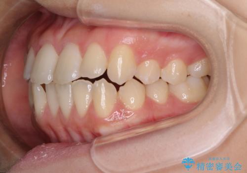 上顎骨拡大を用いたインビザラインによる非抜歯矯正の治療中
