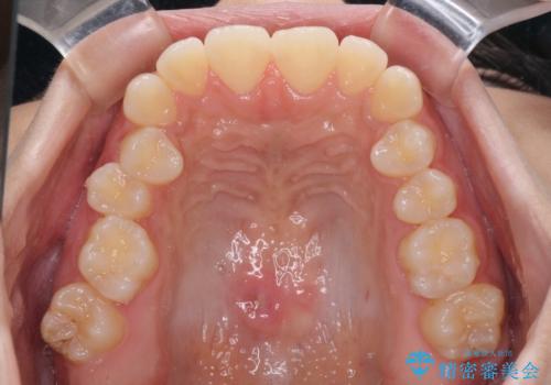 上顎骨拡大を用いたインビザラインによる非抜歯矯正の治療中