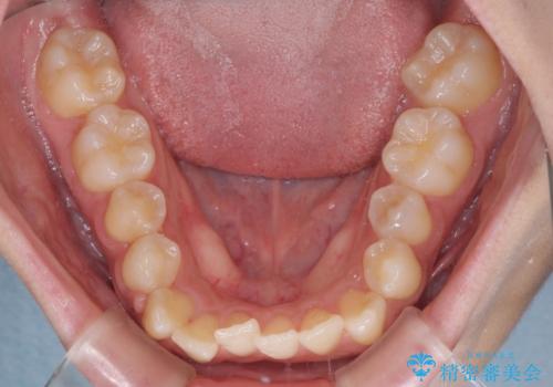 上顎骨拡大を用いたインビザラインによる非抜歯矯正の治療中